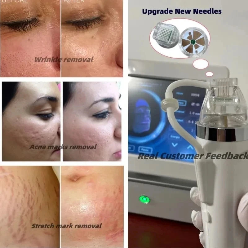 Acne Wrinkle Removal Facial Enhancement means, Scar Removal, Repair, Firming Skin beauty tool